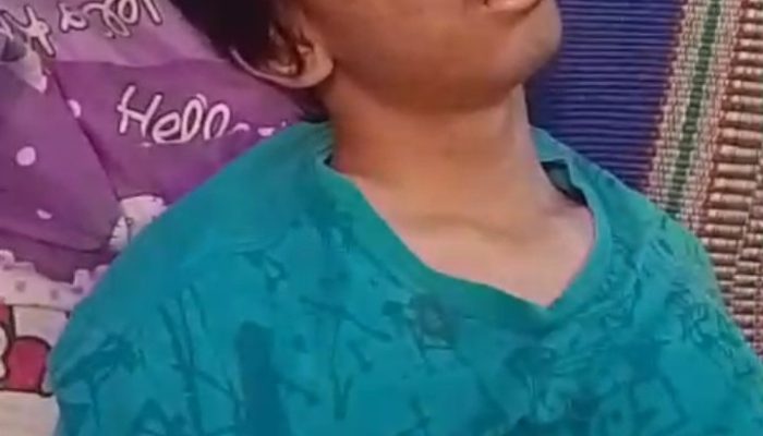 Derita Warga Cirebon Butuh Uluran Tangan, Jalani Pengobatan Dan Dirujuk ke Bandung